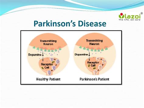 Ppt Parkinsons Disease Overview Symptoms Causes Treatment And The Best Porn Website
