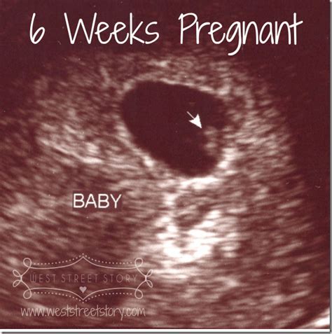 6 Week Pregnancy Ultrasound All About Pregnancy Pinterest Pregnancy Ultrasound Ultrasound