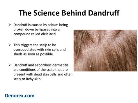 What Is Dandruff