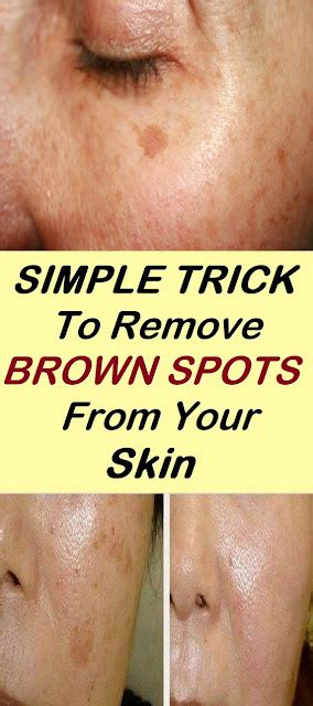 Simple Trick To Remove Brown Spots From Your Skin Healthy Lifestyle