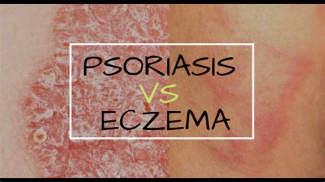 Psoriasis Vs Eczema Which One Are You Suffering From Elimpid