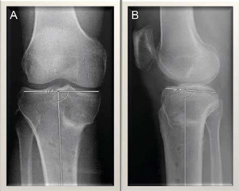 Figure 2 From Uni Condyle High Tibial Osteotomy For Malunion Of Medial
