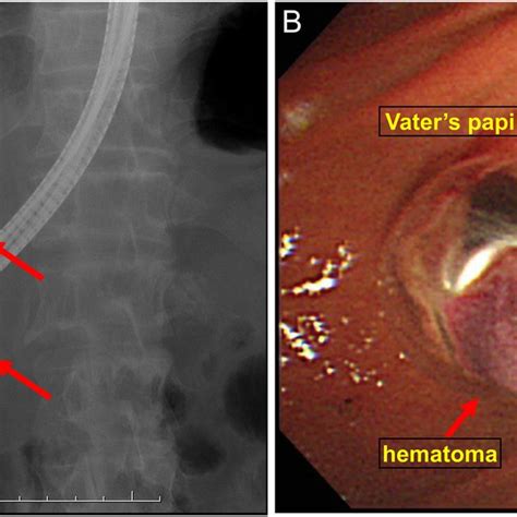 Ercp And The Image Of Vaters Papilla Ercp Showing A Filling Defect