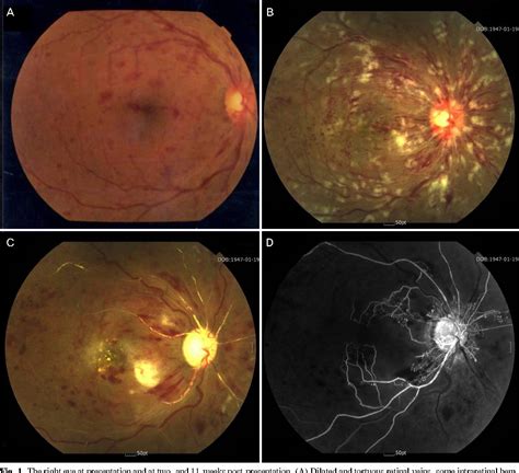 Pdf Progression Of Impending Central Retinal Vein Occlusion To The