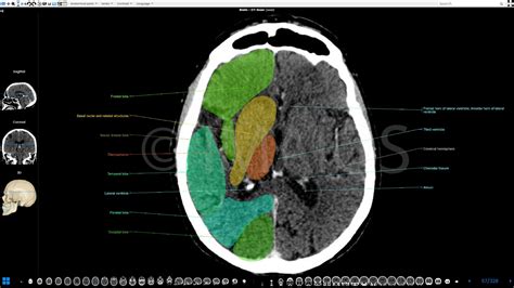 Brain Ct Anatomy Cerebral Lobes Ventricles Brain Anatomy Human