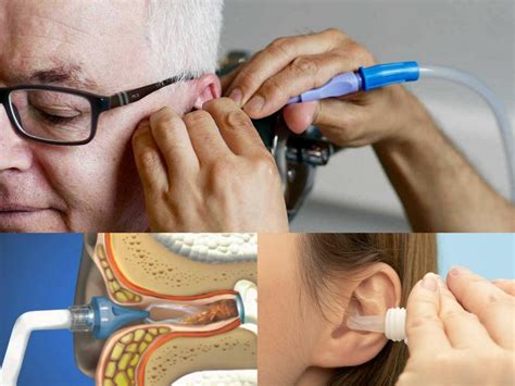 Ear Wax Removal For Tinnitus Treatment Best Tinnitus Treatment Nyc