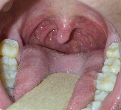 Albums Wallpaper Pictures Of Healthy Tonsils In Adults Latest