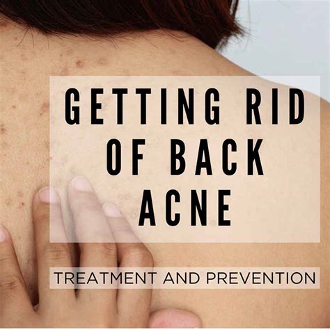 Back Acne Tips To Get Rid Of It Treatments Banish