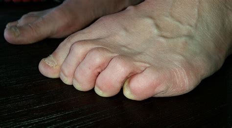 Pinky Toe Blisters Causes And Injury Prevention Blister Prevention
