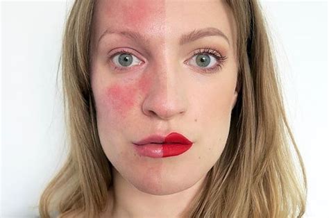 12 Things Everyone With Rosacea Should Know 44 Off