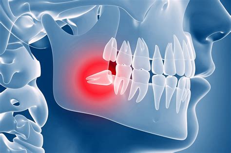 Five Main Reasons For Wisdom Teeth Extraction