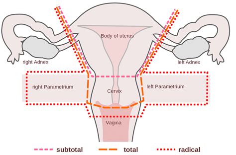 Hysterectomy Procedure Indications Complications TeachMeObGyn