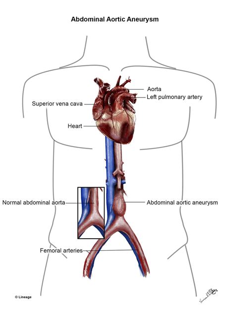 True aneurysms are an abnormal dilation of an artery due to a weakened vessel wall. Abdominal Aortic Aneurysm - Cardiovascular - Medbullets ...