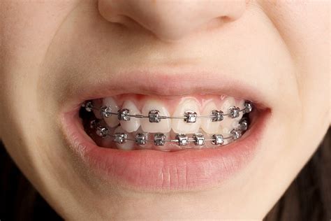 Your Guide To Getting Braces Prepare With This Expert Advice