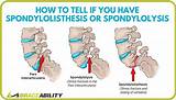Spondylolisthesis Physical Therapy Treatment