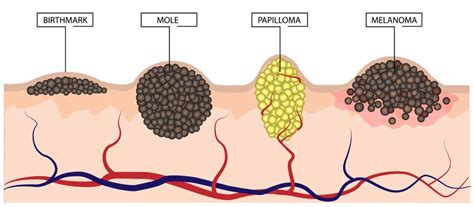 Cancerous Mole Vs Normal Mole