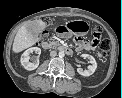 Gallbladder Cancer Liver Case Studies Ctisus Ct Scanning