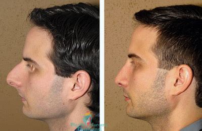 Even after septoplasty, you may continue to have nose block as your problem is more related to sinusitis and rhinitis. Rhinoplasty Bangkok |Nose Augmentation Surgery Reviews ...