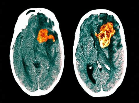 Hope For A Deadly Form Of Brain Cancer Healthtimes