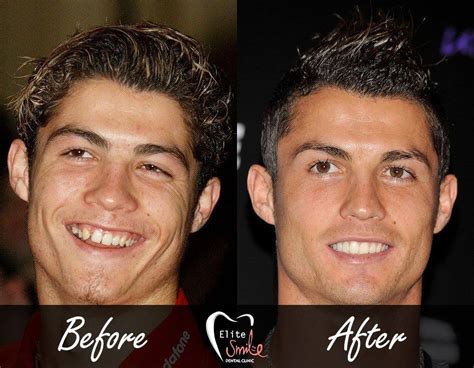 23 pictures celebrity teeth before and after dental pro