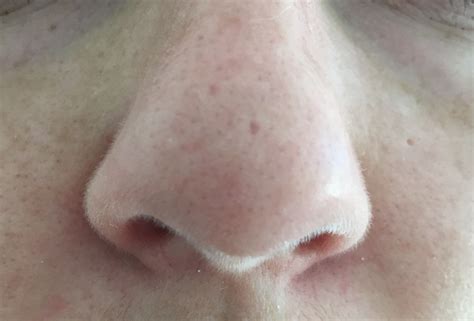 Needling On Tip Of Nose Scar Treatments