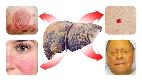 15 Skin Signs That Reveal Your Liver Is In Trouble Hygieia Lifestyle