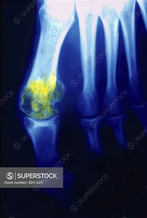 X Ray Showing Gout In Big Toe Superstock