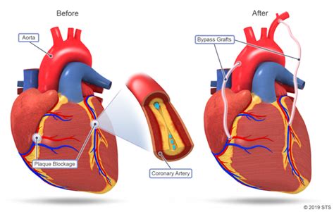 Coronary Artery Bypass Grafting Newport Cardiac And Thoracic Surgery