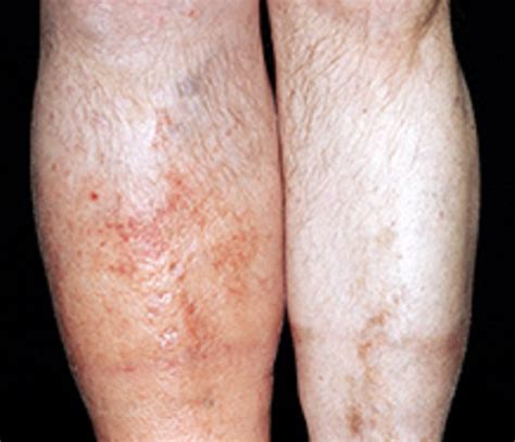 Deep Vein Thrombosis Symptoms Signs And Treatment Supreme Vascular