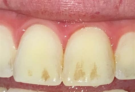 Brown Spots On Front Teeth What Are They Rdentistry