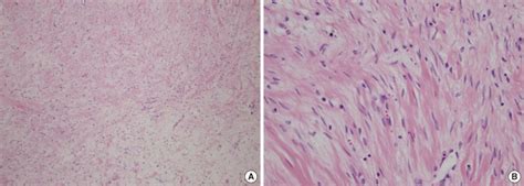 Histological Features Of Myxoid Leiomyoma A Spindle Tumor Cells Are