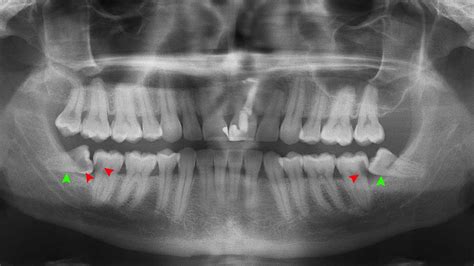 Impacted Wisdom Teeth X Ray