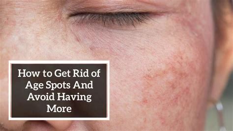 How To Get Rid Of Age Spots And Avoid Having More Youtube
