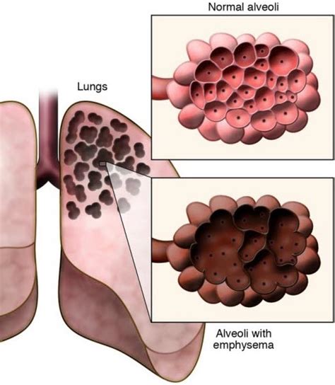 Emphysema Causes Symptoms Diagnosis And Treatment How To Relief