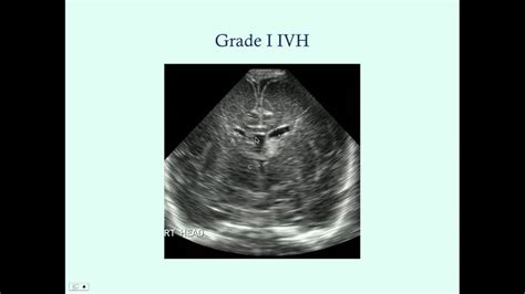 Intraventricular Hemorrhage Grades