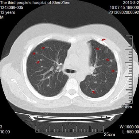 Tumors In Both Lungs And In The Left Third Costal Ct Scans Showed
