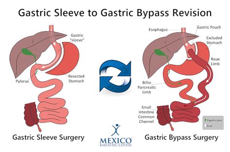 Gastric Sleeve Revision Surgery Mexico Bariatric Center