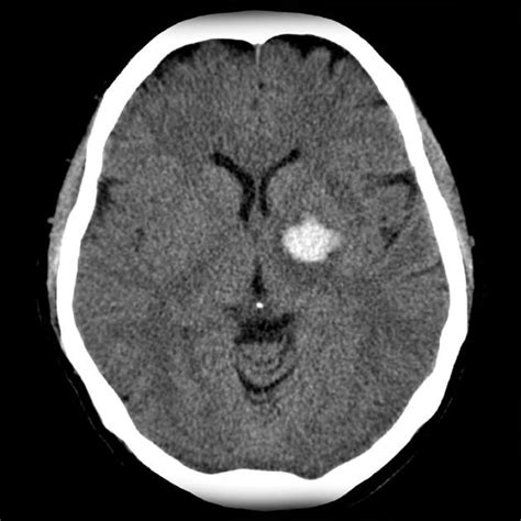 Basal Ganglial Haemorrhage Is A Common Form Of Intracerebral