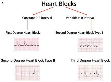 Heart Blocks Ecg Class Criteria Tracings