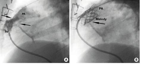 Percutaneous Pulmonary Valve Implantation Congenital Heart