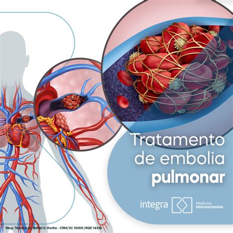 Embolia pulmonar tratamento minimamente invasivo Dica Médica