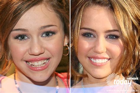 Miley cyrus plastic surgery, stars plastic surgery before ...