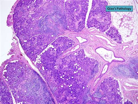Qiaos Pathology Chronic Obstructive Sialadenitis Of The Submandibular