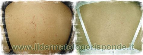 Sarcoidosi cutanea e sistemica: cause e sintomi