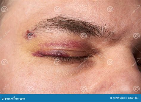 Close View Of A Black Eye Man`s Face With A Hematoma Stock Photo