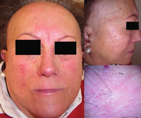 A Frontal Side Mild Centrofacial Fixed Erythema With Telangiectasias