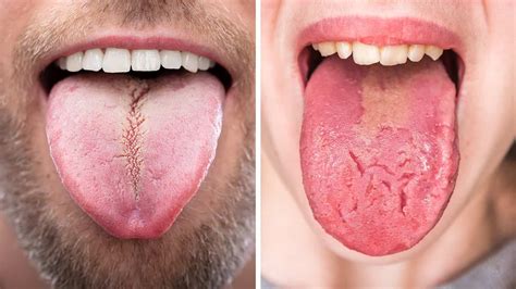What Does Herpes Look Like On Your Tongue What Does