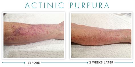 Actinic Purpura Neogenesis Skincare Review For Actinic Purpura