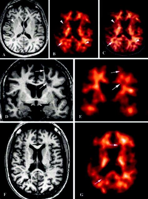 Imaging Of Demyelination And Remyelination In Multiple Sclerosis Radiology Key