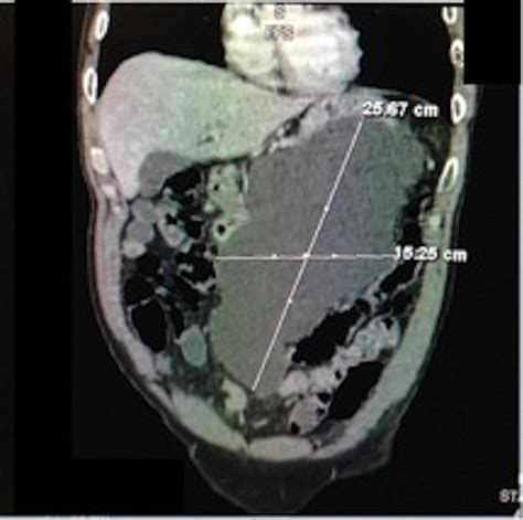 A Giant Pancreatic Pseudocyst Treated By Cystogastrostomy Bmj Case